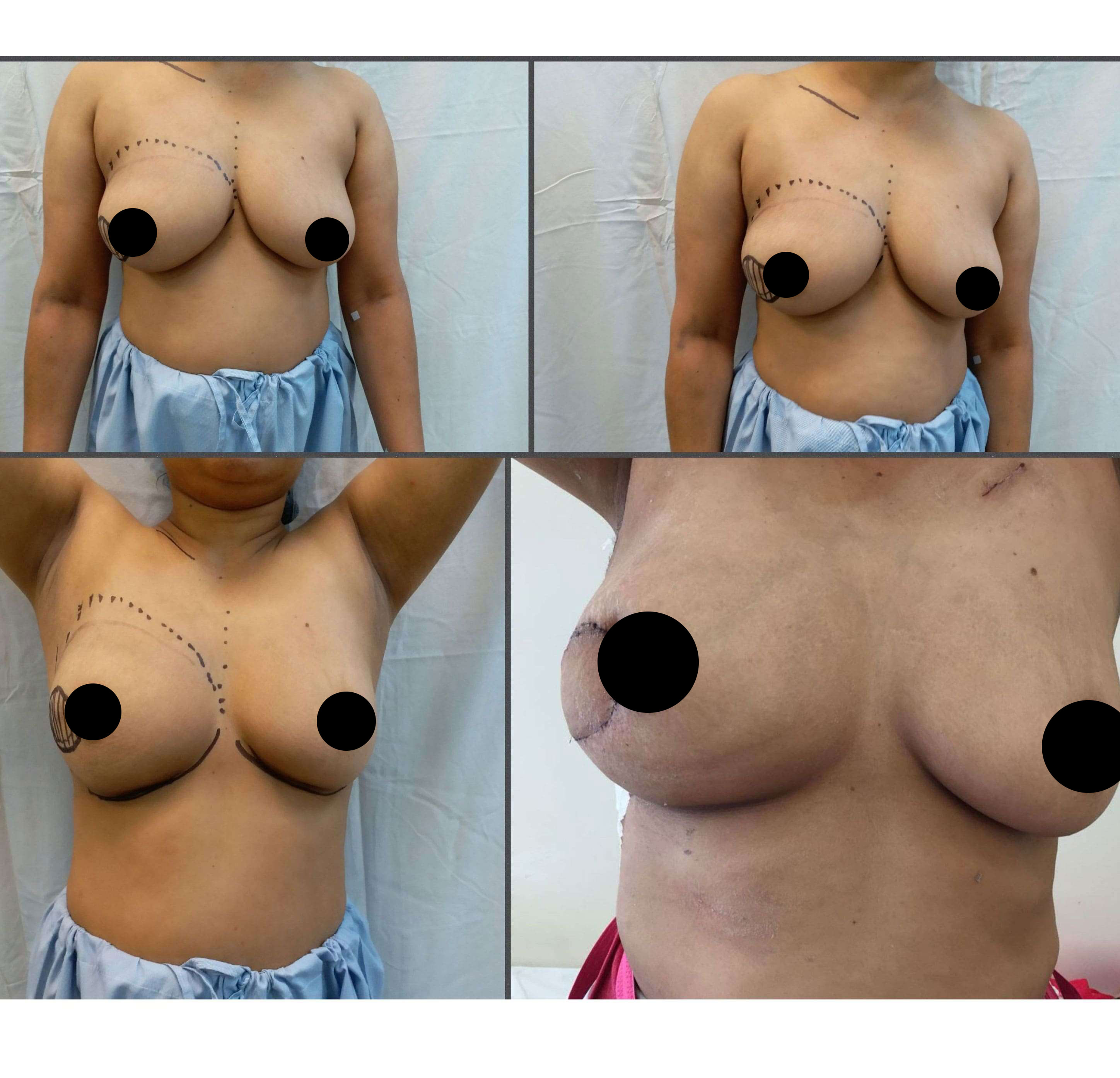 Breast Conservation Surgery with Latissimus Dorsi Flap